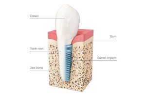 Nobel Biocare Dental Implant