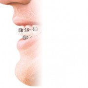 Invisalign abroad in Spain — clear aligners at Asensio Advanced Dentistry Valencia