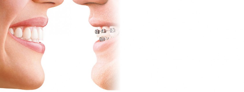 b-invisalign