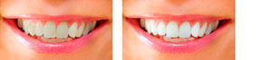 Dental Whitening