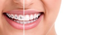 Aestetic Orthodontics