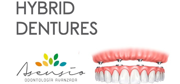 dental implants spain