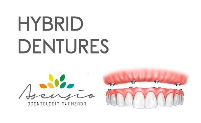 dental implants spain