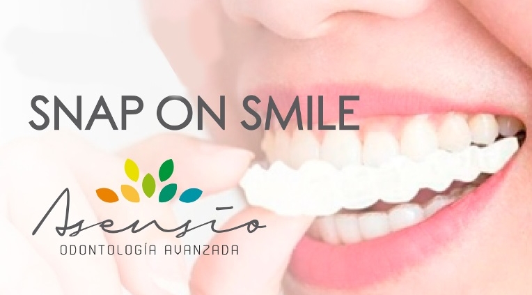 Snap on smile abroad