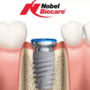 dental implants bone loss