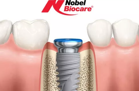 dental implants bone loss