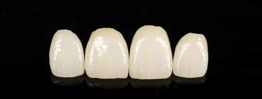 Composite Dental Veneers