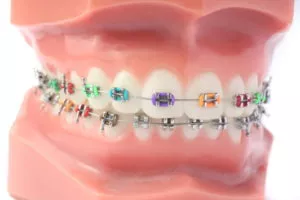 Types of Dental Brackets