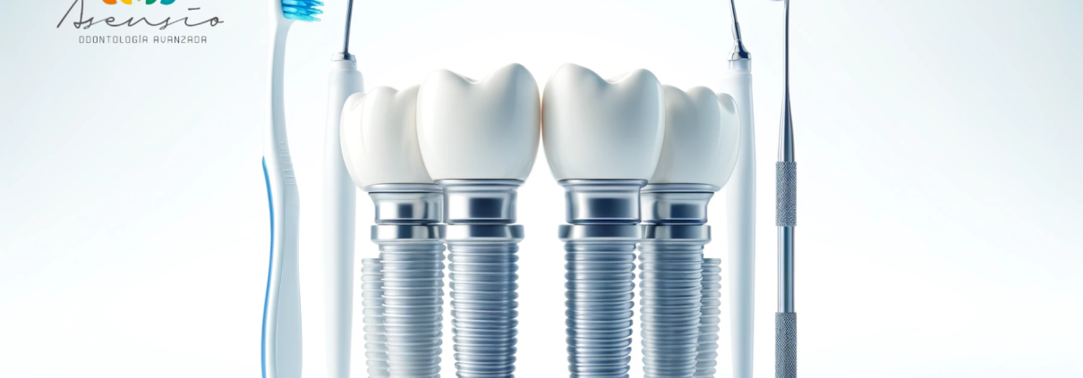 How to Clean All-on-4 Dental Implants