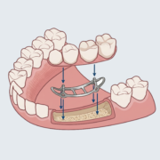 implantes sin tornillos
