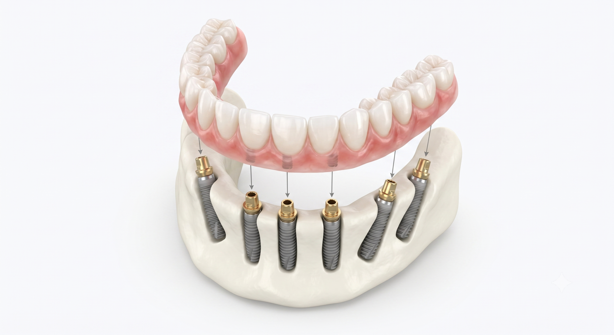 all-on 6 implants