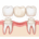 dental bridges abroad cost