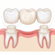 dental bridges abroad cost